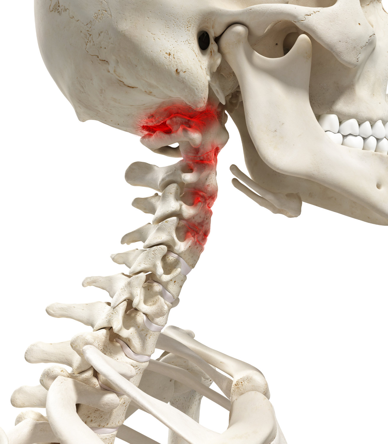 Arthritic cervical spine