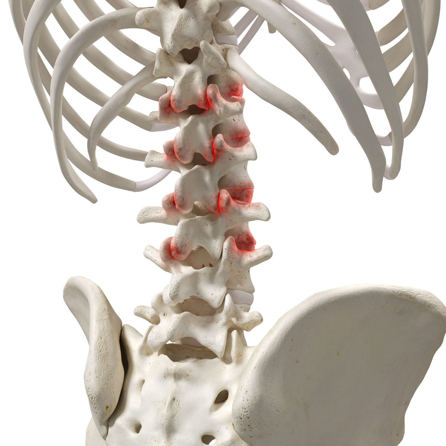 3d rendered medically accurate illustration of an arthritic spine