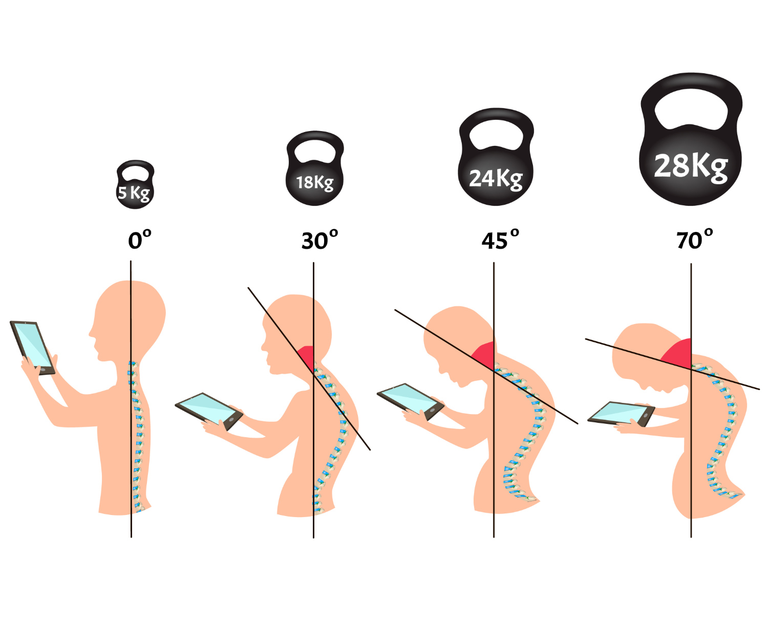 Improper posture symptoms. Stage Text Neck Syndrome. Spinal curvature, kyphosis, lordosis, scoliosis, arthrosis. Improper posture and stoop. Infographics. Vector illustration on isolated background.